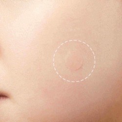 24Pcs Acne Patches Pimple Master Patch Face Spot Scar Care Treatment Stickers Invisible Acne Sticker