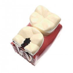Caries Teeth Comparation Model Dental Study Education Demonstration