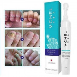 Fungal Nail Treatment Pen Essence Foot Whitening Toe Nail Fungus Removal Feet Care