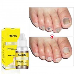 OEDM Nail Treatment Onychomycosis Paronychia Anti Fungal Nail Infection Toe Nail Fungus Treatment