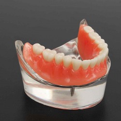 Precision Implants Restoration Teeth Demo Model Dental Overdenture Emulational