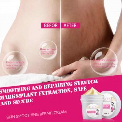 Stretch Mark Removal Cream Postpartum Scar Obesity  Mask Powerful  Scar  Removal Cream