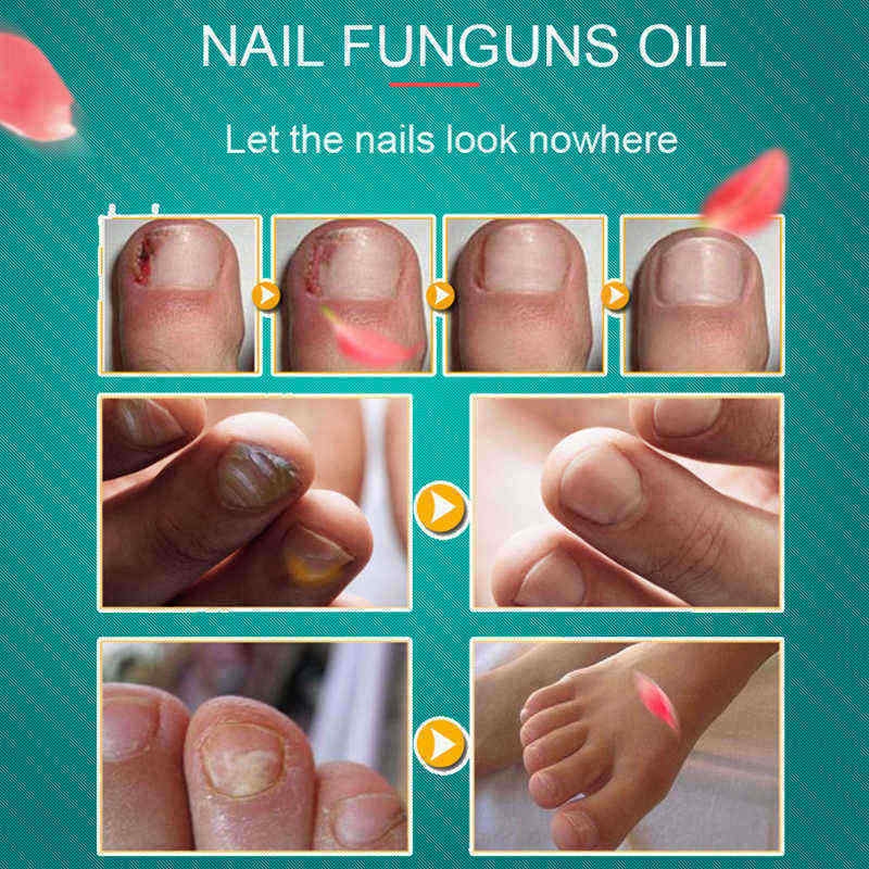 10ML-Fungal-Nail-Treatment-Nail-Nutrient-Solution-Repair-Nail-Moisturizing-Nail-Care-Tool-1331643