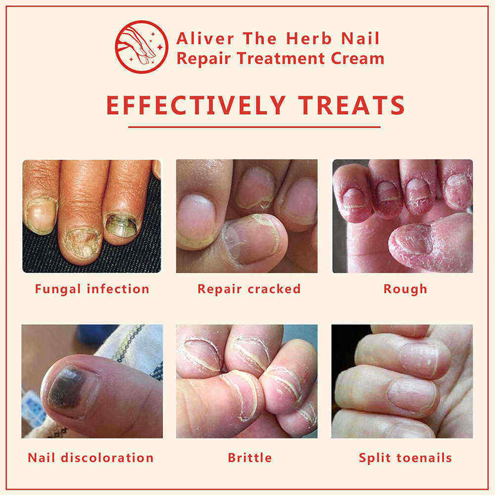 15g-Nail-Repair-Cream-Toenail-Fungus-Treatment-Exfoliating-Dead-Skin-Sterilization-Nail-Cream-1333530