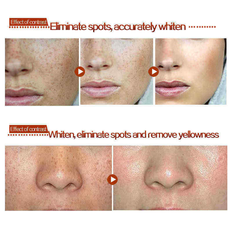 Age-Spot-Melasma-Remove-Freckle-Face-Cream-Whitening-Lightening-Skin-Care-1172509