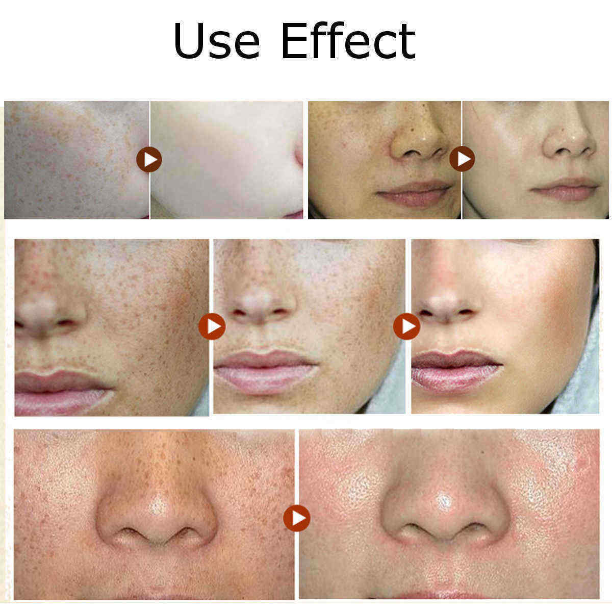 Age-Spot-Melasma-Remove-Freckle-Face-Cream-Whitening-Lightening-Skin-Care-1172509