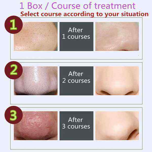 Blackhead-Purifying-Nose-Stickers-Mask-Acne-Pore-Removal-Solution-Liquid-Set-Purifying-Cleaner-1070738