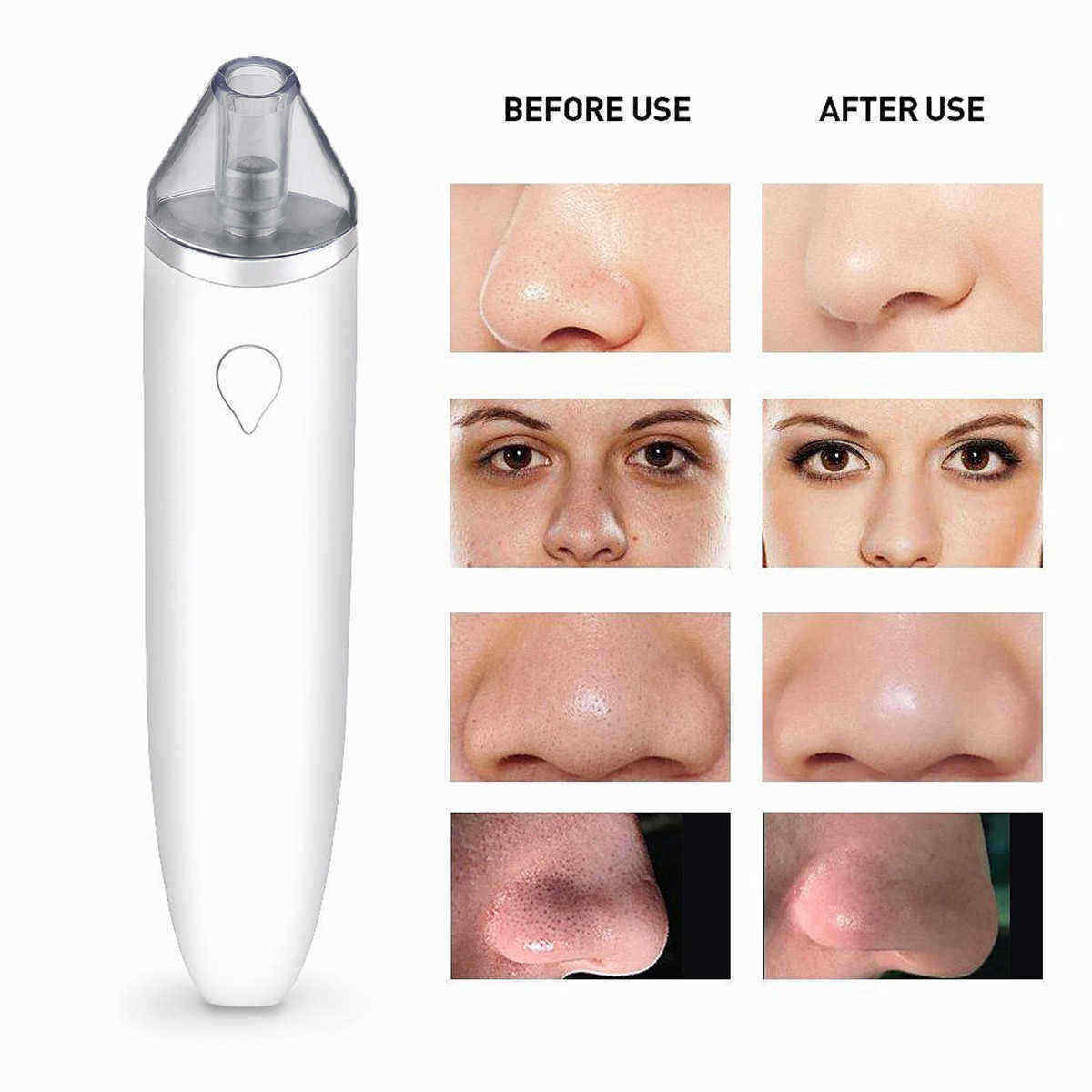 Blackhead-Remover-Comedone-Extractor-Acne-Pimple-Vacuum-Suction-Multifunctional-Skin-Device-1261190