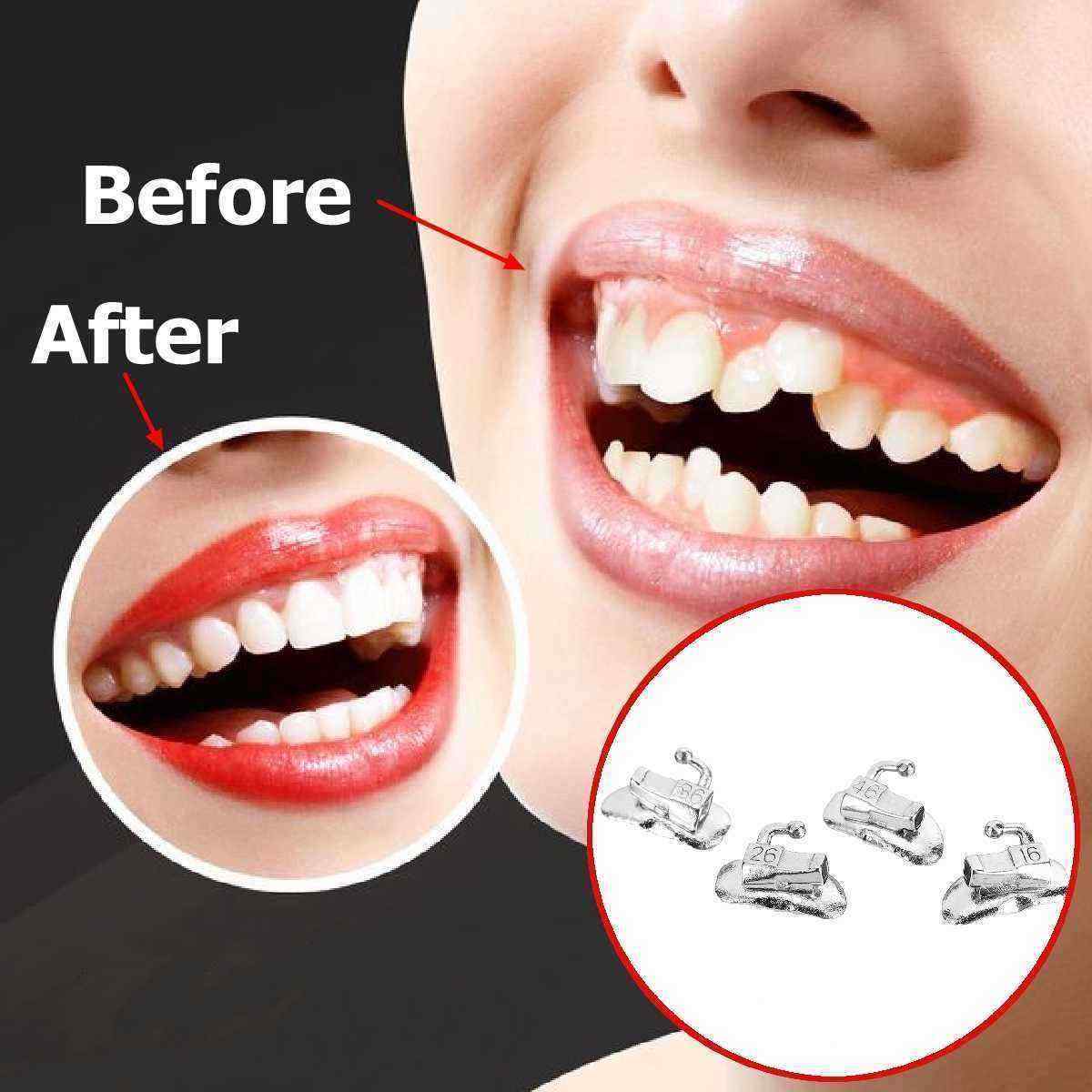 Dental-Orthodontic-Buccal-Tube-Tools-1498885