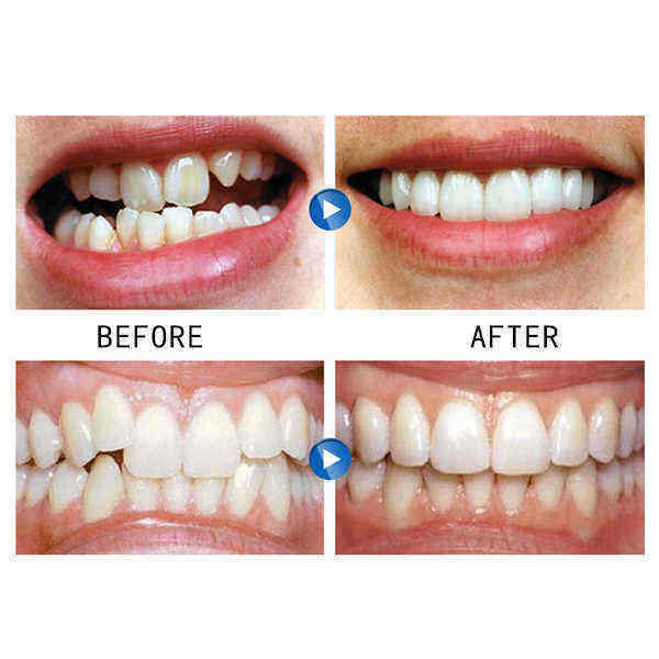 Dental-Tools-Braces-Orthodontics-Invisible-Teeth-Holders-Help-You-Sleep-1244655