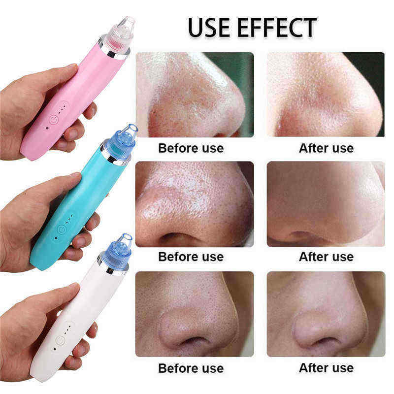 Electric-Blackhead-Suction-Acne-Remover-Vacuum-Pores-Cleanser-Microdermabrasion-Lift-Device-1256705