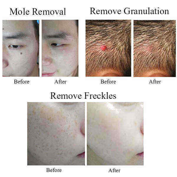 Facial-Black-Spot-Extractor-Tools-Rechargeable-Freckle-Laser-Spot-Laser-Beauty-Mole-Removal-Machine--1164477
