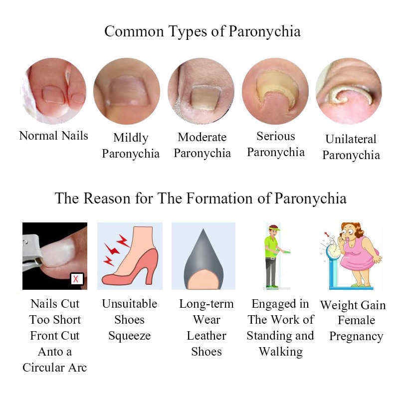 Ingrown-Toenail-Straightening-Clip-Curved-BS-Brace-Toenails-Thick-Paronychia-Correction-Tool-1154773