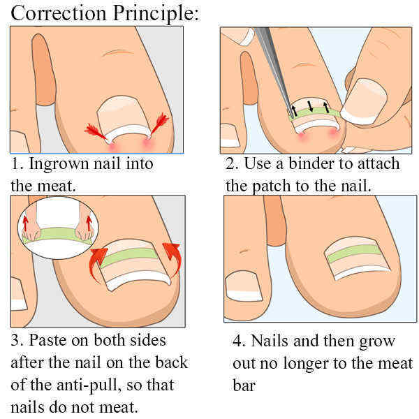 Ingrown-Toenail-Straightening-Clip-Curved-BS-Brace-Toenails-Thick-Paronychia-Correction-Tool-1154773