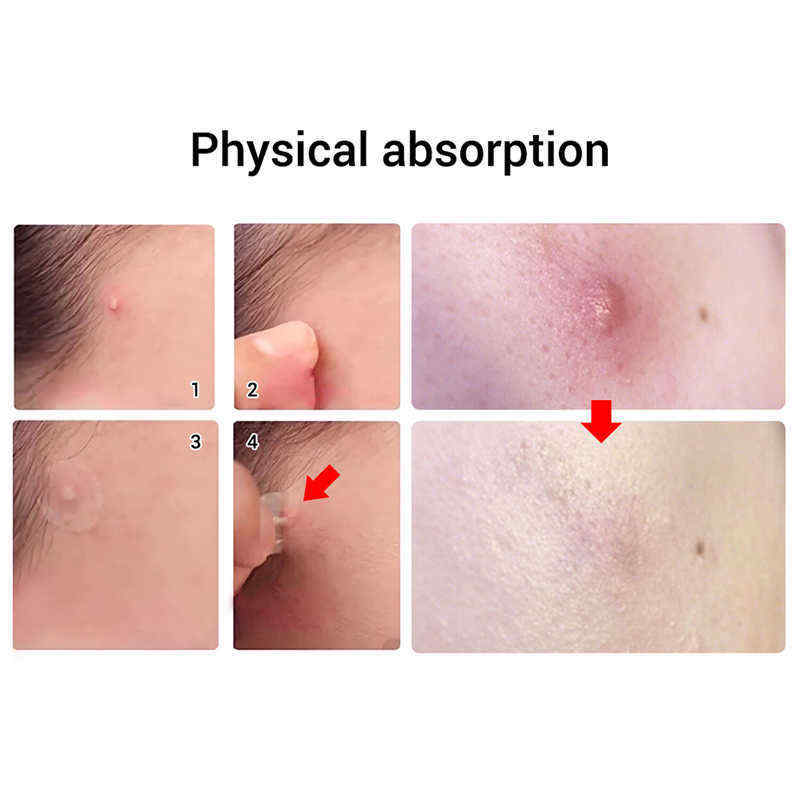 LANBENA-Tea-Tree-Daily-Acne-Stickers--Night-acne-Stickers-Fade-Blackhead-Acne-Remover-1538280
