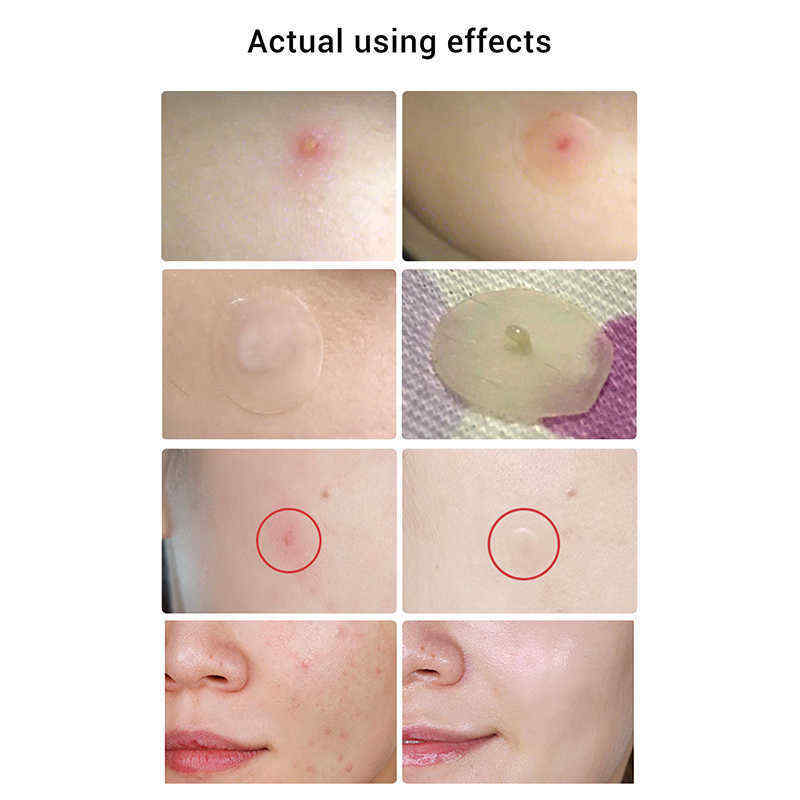 LANBENA-Tea-Tree-Daily-Acne-Stickers--Night-acne-Stickers-Fade-Blackhead-Acne-Remover-1538280