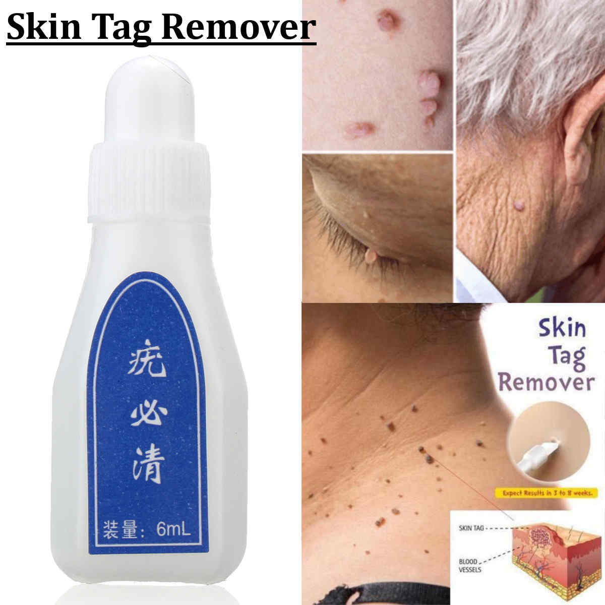 Skin-Wart-Removal-Liquid-Skin-Tag-Mole-amp-Genital-Wart-Remover-12-Hours-Kill-Skin-Care-1370772