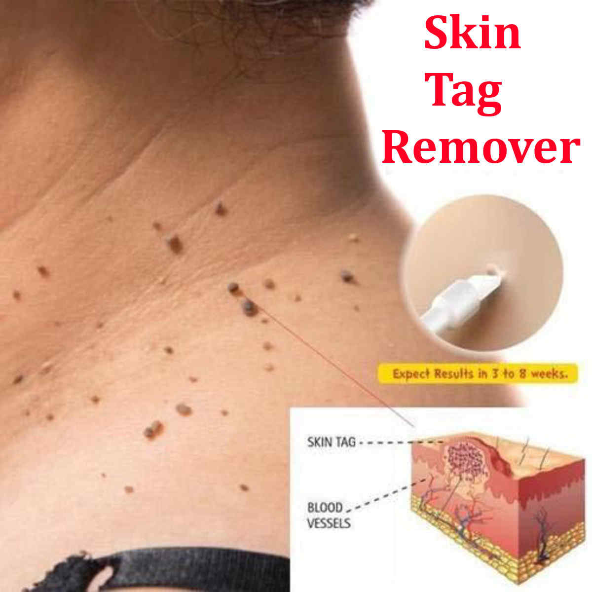 Skin-Wart-Removal-Liquid-Skin-Tag-Mole-amp-Genital-Wart-Remover-12-Hours-Kill-Skin-Care-1370772