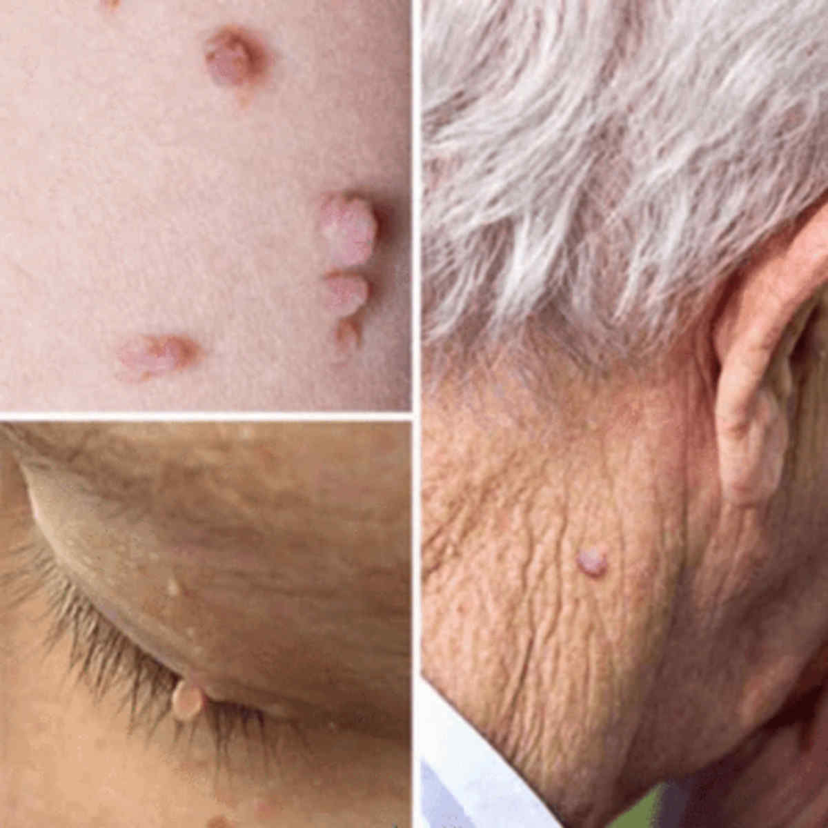 Skin-Wart-Removal-Liquid-Skin-Tag-Mole-amp-Genital-Wart-Remover-12-Hours-Kill-Skin-Care-1370772