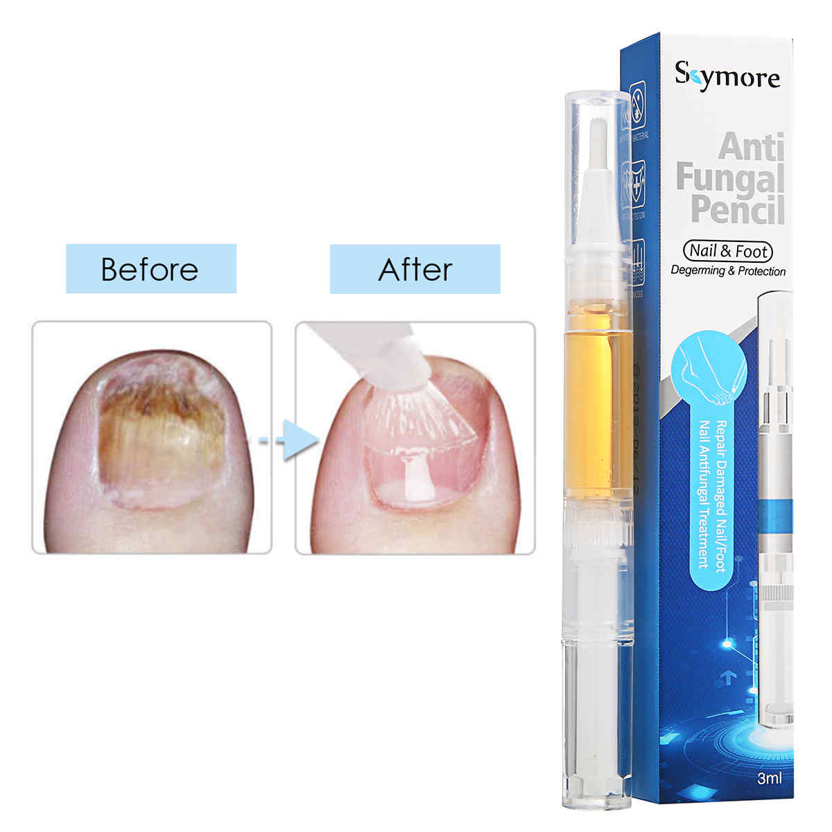 Skymore-Toenail-Fungus-Treatment-Fungal-Nail-Gel-with-Nail-File-Toenails-amp-Fingernails-Solution-1292874