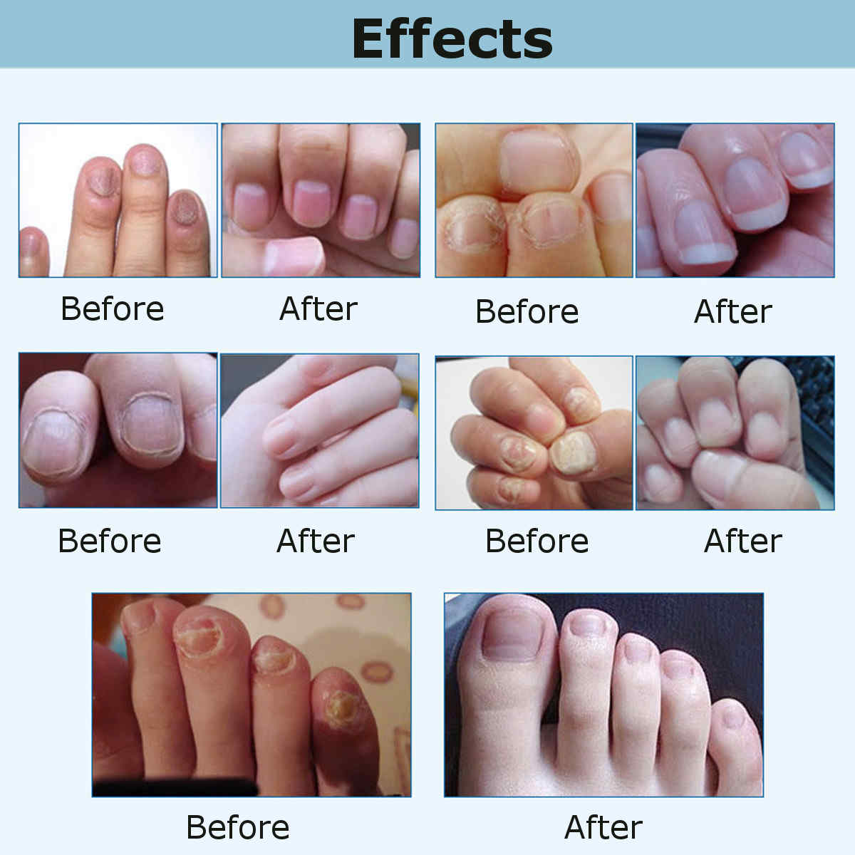 Skymore-Toenail-Fungus-Treatment-Fungal-Nail-Gel-with-Nail-File-Toenails-amp-Fingernails-Solution-1292874