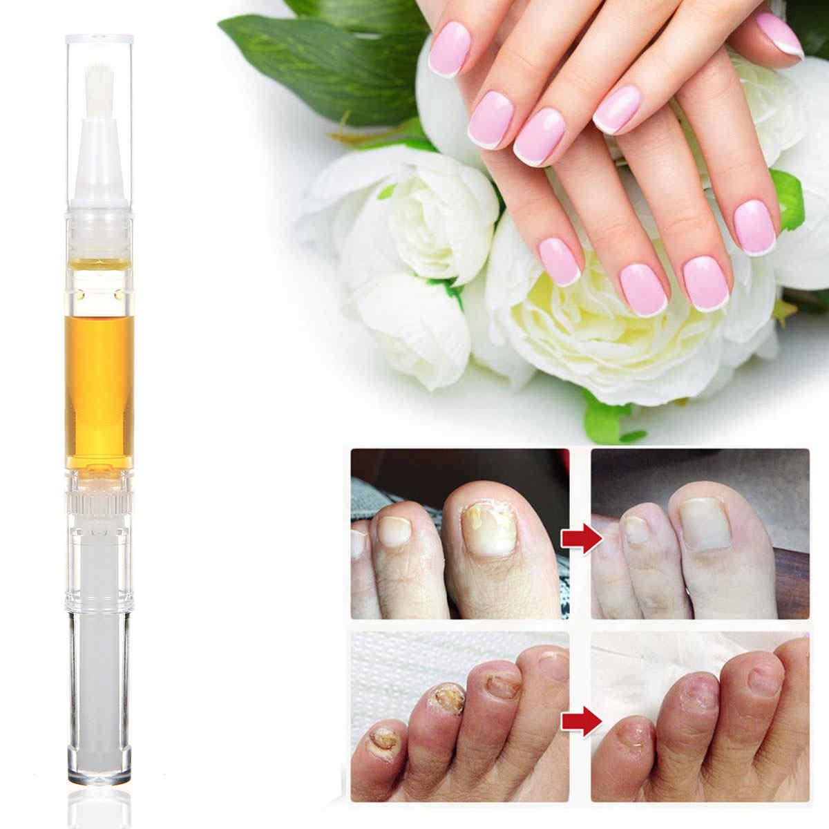 Skymore-Toenail-Fungus-Treatment-Fungal-Nail-Gel-with-Nail-File-Toenails-amp-Fingernails-Solution-1292874