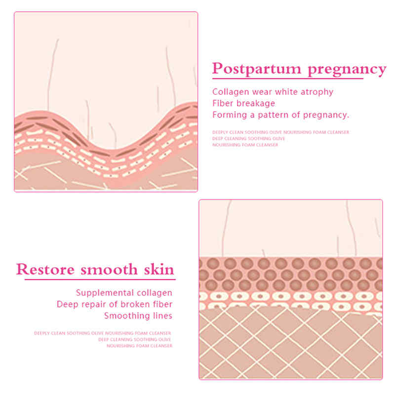 Stretch-Mark-Removal-Cream-Postpartum-Scar-Obesity--Mask-Powerful--Scar--Removal-Cream-1347300