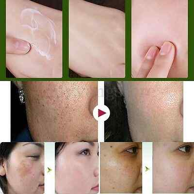 Suction-Spot-Cream-Face-Care-Whitening-Remove-Freckle-Dark-Spots-Scar-Whitening-Cream-1149757