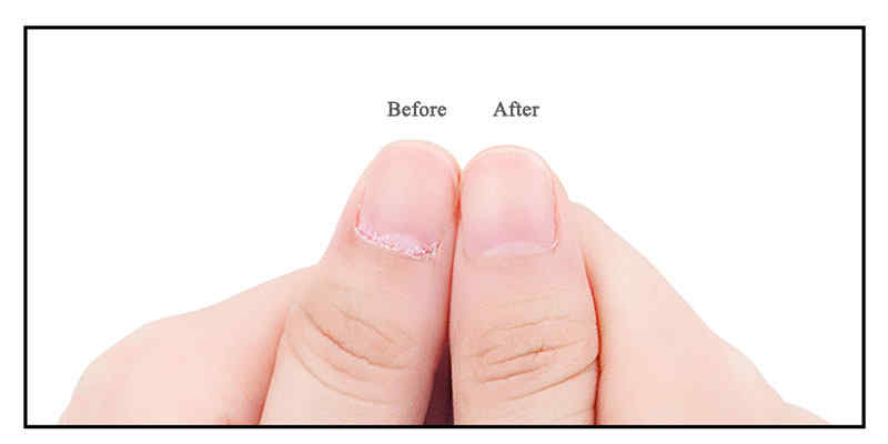 YFMreg-Stainless-Steel-Ingrown-Toenails-Cutter-Nipper-Clipper-Paronychia-Care-Dead-Skin-Pliers-1321366